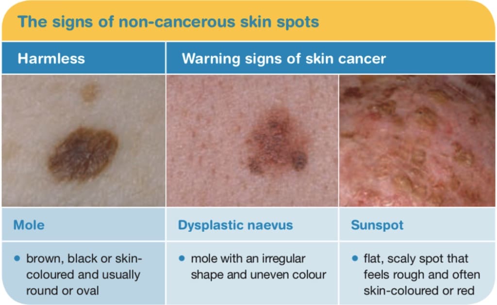 Worried About a Sun Spot? Cancer Signs to Watch Out For (Skin Health)