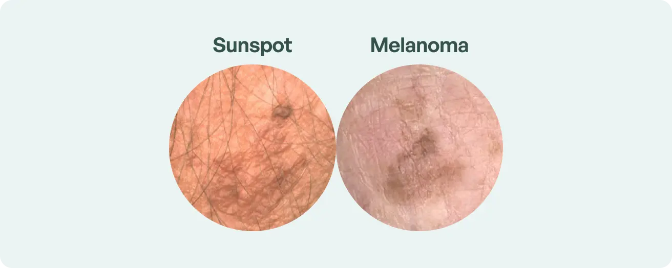 Can Sun Spots Turn into Cancer? Get the Facts on Skin cancer risk