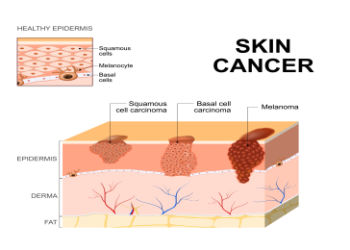 Can Sun Spots Turn into Cancer? Get the Facts on Skin cancer risk