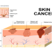 Can Sun Spots Turn into Cancer? Get the Facts on Skin cancer risk