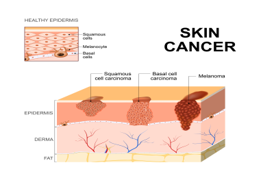 Can Sun Spots Turn into Cancer? Get the Facts on Skin cancer risk